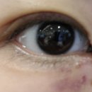 덴탈 푸르고 | 쌍수 후기(쌍수 전~1달 반까지)