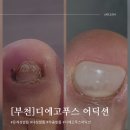 어딕션 | 부천 문제성발톱 디에고푸스 어딕션 내돈내산 찐후기