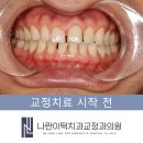 부평스마트치과의원 | 부평시장치과 치아에 부착하는 교정 장치 부담된다면, 인비절라인 투명교정으로