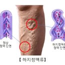 " 하지 정맥류(Varicose veins) " 이미지