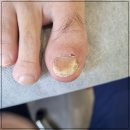 회천의원 | 양주 덕계동 내성발톱 고려마디튼튼 효과적 관리 추천