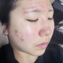 (주)민메디칼 | 사춘기 여드름, 피부과 가기 전에 꼭 보세요! 단 3주 만에 달라진 기적의 홈케어 임상