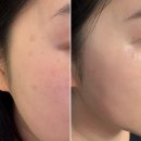 예쁨주의쁨의원 | 신논현피부과 흑자레이저 예쁨주의쁨의원 후기