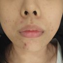 에이블케어 | 부천 에이블메디스킨 ㅣ트러블, 여드름, 웨딩케어 후기