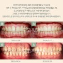 삼성기공사 | 삼성역 주변 치아 라미네이트 진료 치과