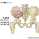 육종[sarcoma] 이미지