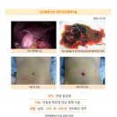 만성담낭염수술후기. 담석으로 인한 복통으로 다른 병원을 찾은 건 7년 전쯤입니다. 그 뒤로 피자, 돈까스 등 기름진 음식을 먹으면... 이미지