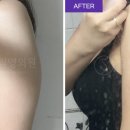 잘된케이스 | 팔 지방흡입 잘된 케이스 특징 팔 지방흡입 잘된 케이스 특징은 의외로 단순합니다