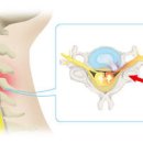 목디스크 원인 초기 진단 이미지