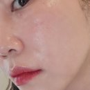 송피부과의원 | 한남동피부과 줄기세포주사 스킨부스터 1주차 엠보 통증 효과 내돈내산 후기