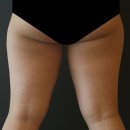 청담마이의원 | 청담 비만클리닉, 비만 유형별 다이어트 방법!