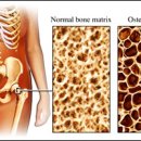 골다공증의 치료 및 예방 이미지