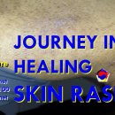 Skin Rashes Healing Journey with KOSA Acupuncture 이미지