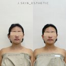 대구 동성로 윤곽관리 '제이스킨' 윤곽+데콜테 솔직후기