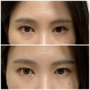 선릉역 약국 | 선릉역 피부과 눈밑필러 시술 후 전후 모습 비교 멍 다운타임