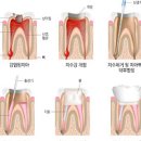 치과 신경치료 기간 및 시간 통증 비용 과정 : 치아 신경치료 후 통증 이미지