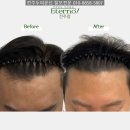 명도헤어라인 네이버블로그