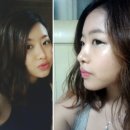 세현성형외과 | 세현성형외과 비대칭 복코수술 후기사진입니당!ㅎㅎ