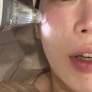 부산마이크로병원 | 부산 포텐자 서브시전 블룸새살침 - 모공 흉터 치료 내돈내산 후기(효과, 가격)