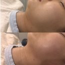 서하뷰티 | 오송 피부관리 서하뷰티 이중턱 제거 에스테틱 후기