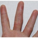 나을한의원 | 한포진한의원을 잘 선택해야 나을 수 있습니다