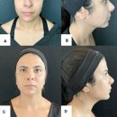 전의를디자인하는사람들 | 광화문 피부과전문의 울쎄라피 프라임? 이 글로 종결합니다.