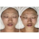 에이뉴(ANEW) | 모델 소피아님의 비포애프터