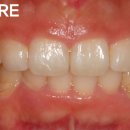 물방울치과의원 | 대구 잇몸성형 치료 후기 | 물방울레이저