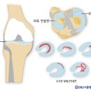 [무릎 이상훈의 무릎 이야기] 관절 연골과 닮은 듯 안 닮은 듯, 반월상 연골판 이미지