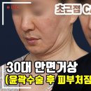 윤곽수술 후 처짐이 온 30대 남성의 안면거상 회복과정! 리프팅의 끝판왕이라고 할 만 하죠？？ 이미지