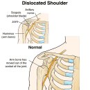 견관절탈구(shoulder dislocation) 이미지