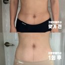 두유러브 - 강남구 논현로159길 32 | 대구 지방분해주사 2-3회차 출산 후 관리 러브핸들 제거후기
