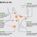 목에 멍울 만져지는데 이미지