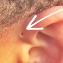 자주고름 | 선천성 귀 이루공 냄새 피지 고름 부음 수술 보험 병원 후기 관리