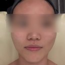 힐링 & 필링 시낭송 | 포항 장성동 에스테틱 내돈내산 추천 리셋 필링 옥시젠 여드름 피부관리 재재재방문 후기 : 온화에스테틱