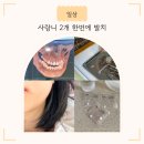 뉴욕치과병원 | 사랑니 2개 발치 후 통증/주의사항/소독/후기(운정뉴욕정치과)