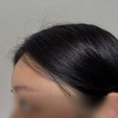 6 | 이마필러 4cc 추가 6개월 후기 내돈내산