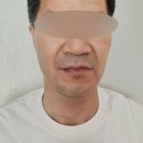 민트성형외과의원 | [강남 신논현 50대 리프팅시술] 플레저성형외과에서 아빠 민트실리프팅 12줄 내돈내산 시술 후기