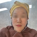 유튜브 채널 운영 및 관리 | 도도쌤 유튜브 보고 받은 온다 리프팅 시술 후기(전후사진, 통증, 부작용, 가격)