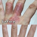 대수약국 | 약국 디판테놀 연고 건선 습진 홈케어 극복 후기