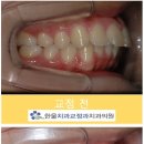 산본치과 돌출입교정후기 늦기 전에 결정해요