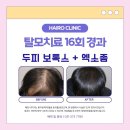 미작의원 | 수원 모발이식 성지 결정하기 전 놓치기 쉬운 부분들