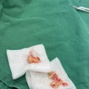 용당퍼스트치과의원 | 매복 사랑니 후기 [ 퍼스트사랑니 치과의원 ]