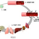 패혈증(Sepsis) 이미지