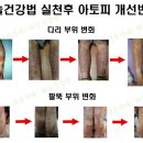 아토피, 아토피에좋은음식과 치료법1 이미지