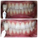 L&B치과의원 | [강남 363치과]강남 신사역 레브치과 치아미백 후기