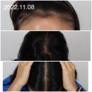 분당맥스웰의원 | 탈모약 치료제 부작용 효과 영양제 추천 정수리탈모 M자 탈모 예방법 총정리!!!(Feat.멕스웰피부과)