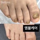 엠블케어 | 병원에서도 해결 못했던 무좀·내성발톱, 단 1회만에 해결해준 엠블케어