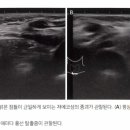 흉선 탈출증(Superior herniation of thymus) 이미지