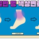 멍피